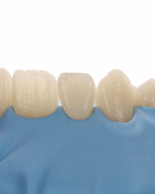 Peg lateral - sonrası