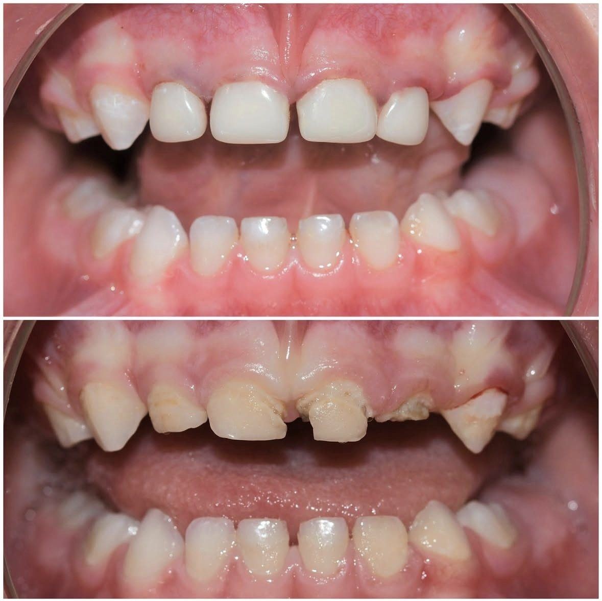 Kompozit bonding öncesi ve sonrası